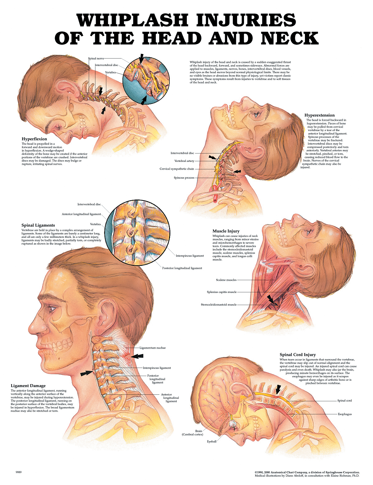 Neck injury